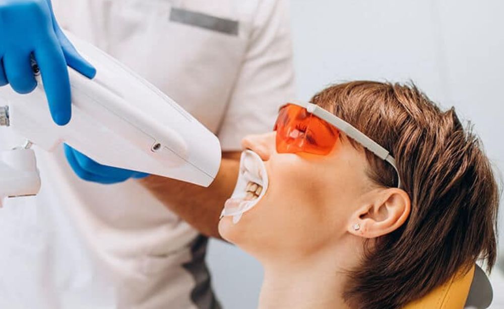 Blanqueamiento dental Beneficios