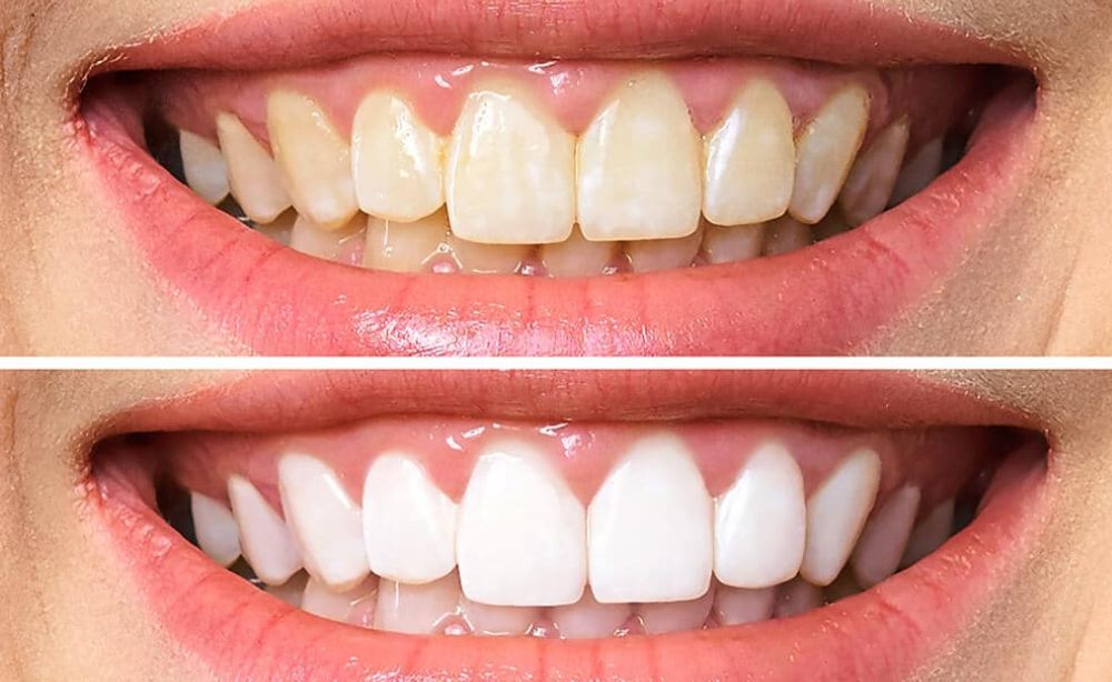 Blanqueamiento dental qué es