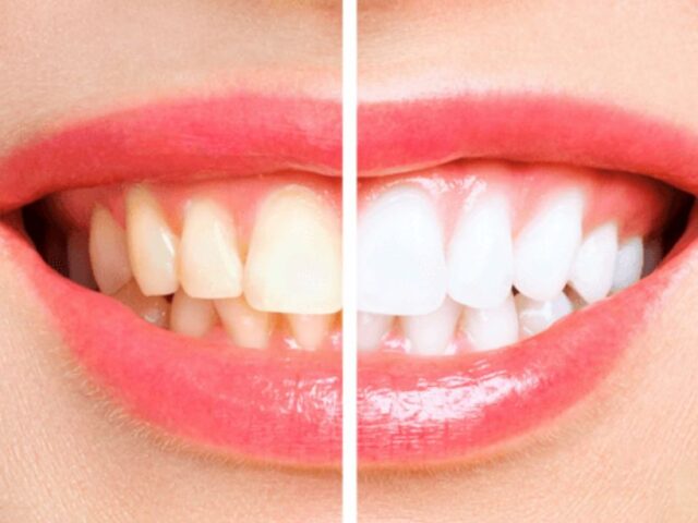 Blanqueamiento dental tratamiento