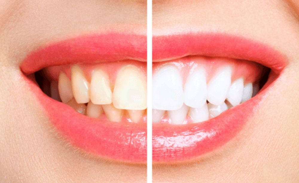 Blanqueamiento dental tratamiento