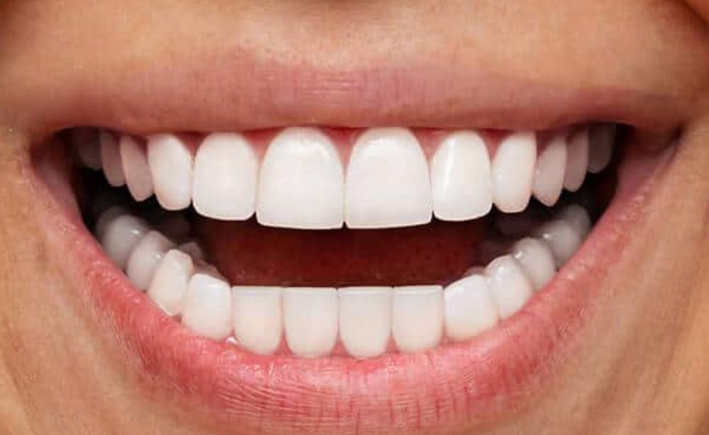 Carillas Dentales qué son