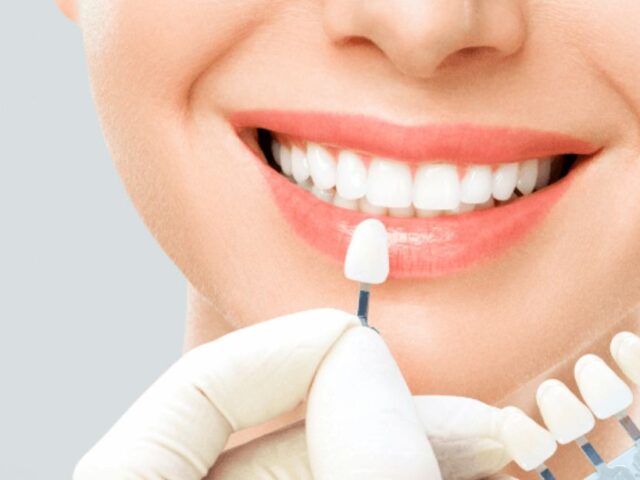 Carillas dentales Tratamiento