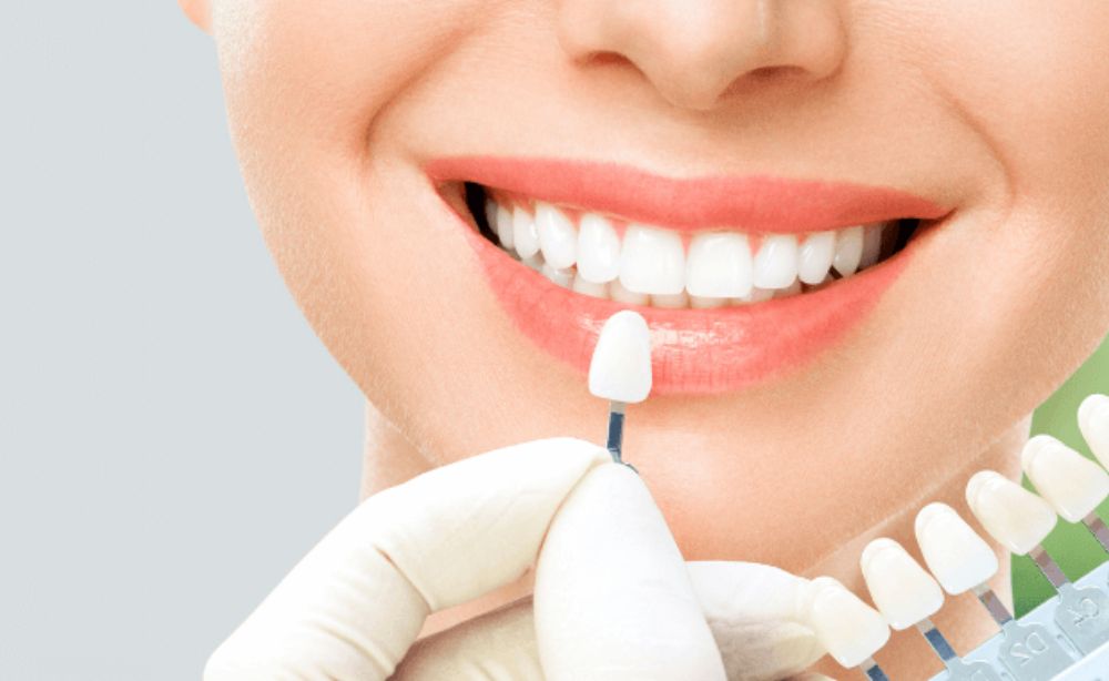 Carillas dentales Tratamiento