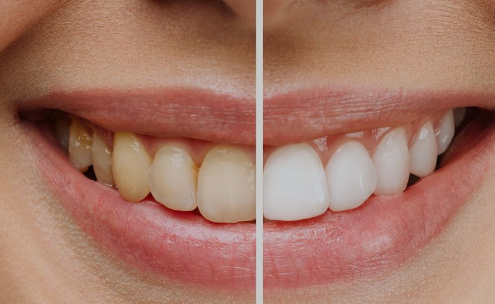 Manchas en los dientes causas y tipos