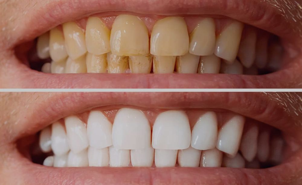 Manchas en los dientes información