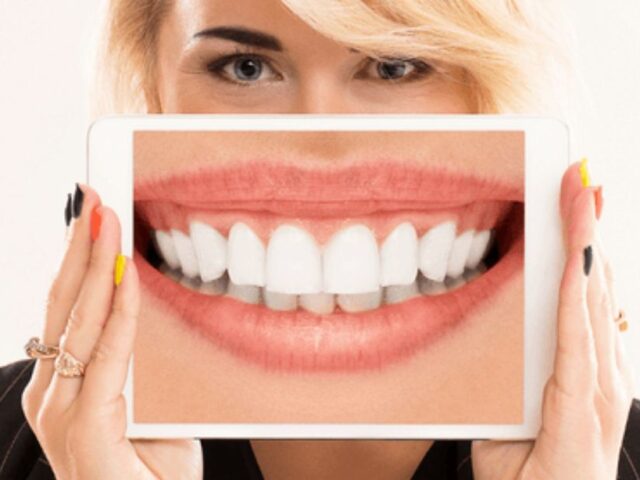 Tipos de sonrisas información