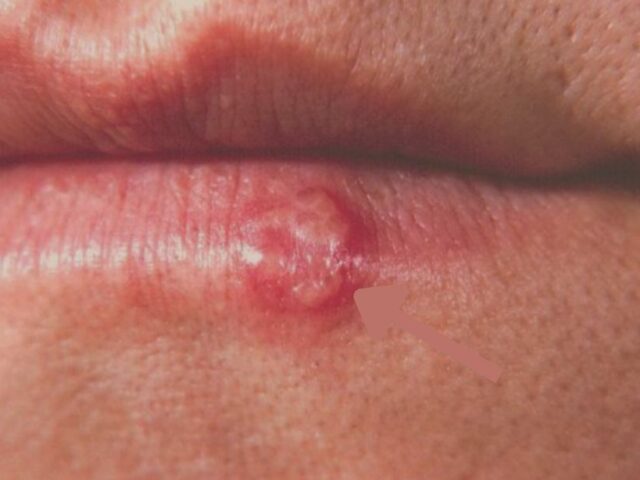 Herpes labial qué es información
