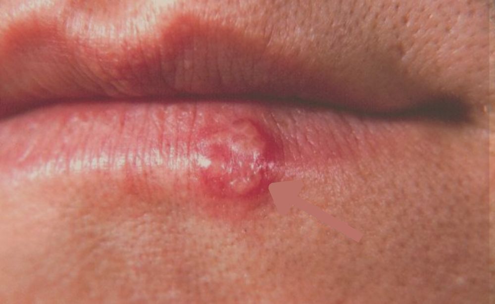 Herpes labial qué es información