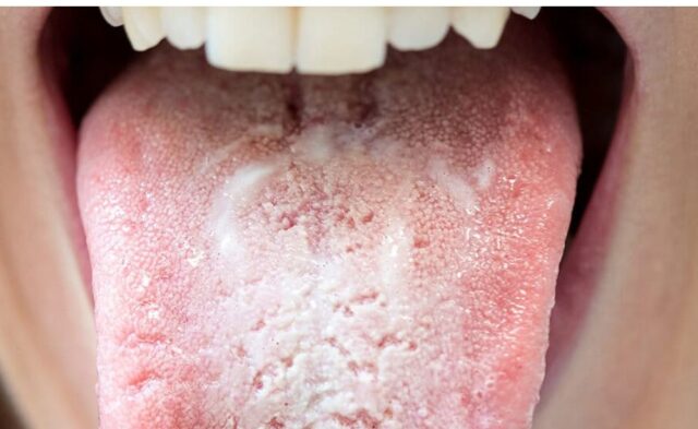 Manchas Blancas En La Lengua Descubre Sus Causas Y Los Tratamientos manchas-blancas-en-la-lengua-descubre-sus-causas-y-los-tratamientos